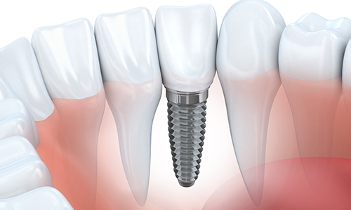 Dental Implants in West Lethbridge