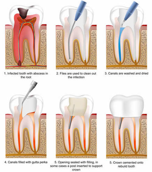 Root Canals in West Lethbridge